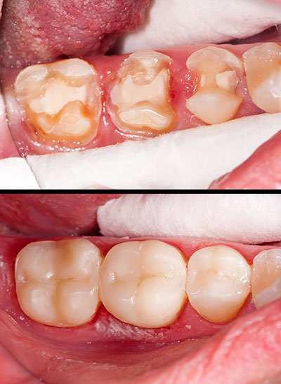 Wellwood Family Dentistry | Dental Bonding, Dental Lab and At-Home Whitening