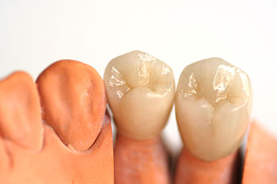 Wellwood Family Dentistry | Implant Retained Dentures, In-Office Whitening and At-Home Whitening