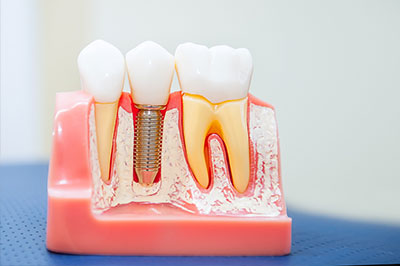 Wellwood Family Dentistry | Dental Implants, Smile Assessment and Dental Cleanings