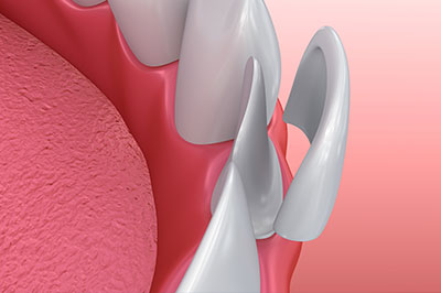 Wellwood Family Dentistry | Dentures  amp  Partials, Dental Bridges and Adult Orthodontics