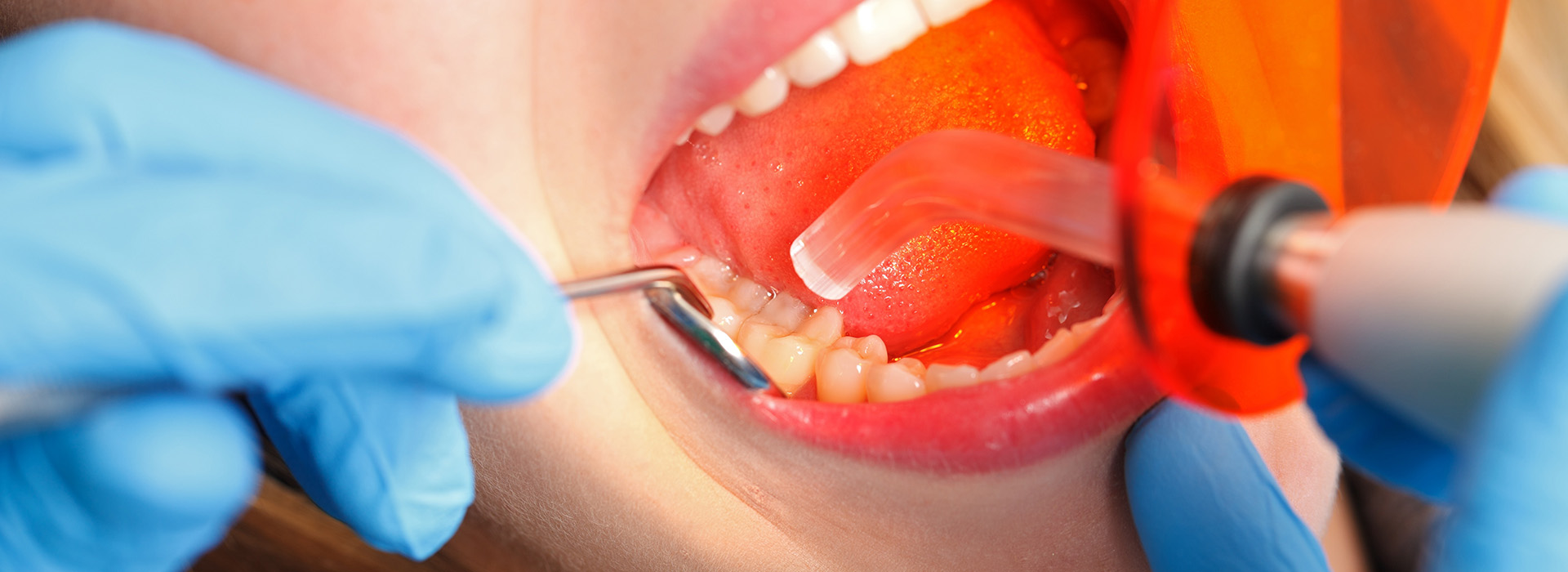 Wellwood Family Dentistry | In-Office Whitening, Dental Implants and All-On-X