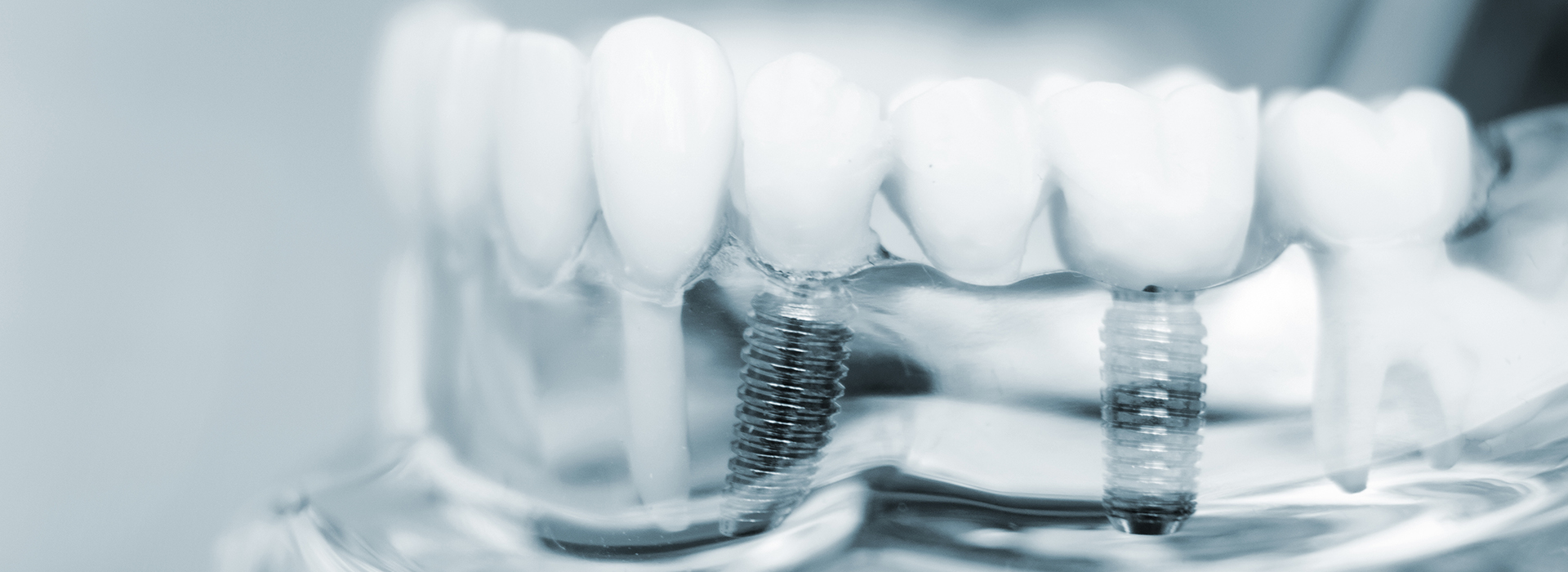 Wellwood Family Dentistry | Digital Impressions, At-Home Whitening and Smile Makeover