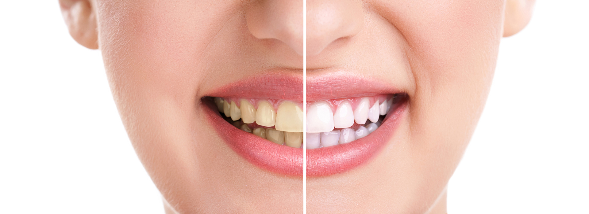 Wellwood Family Dentistry | Full Mouth Reconstruction, Extractions and Dental Bonding